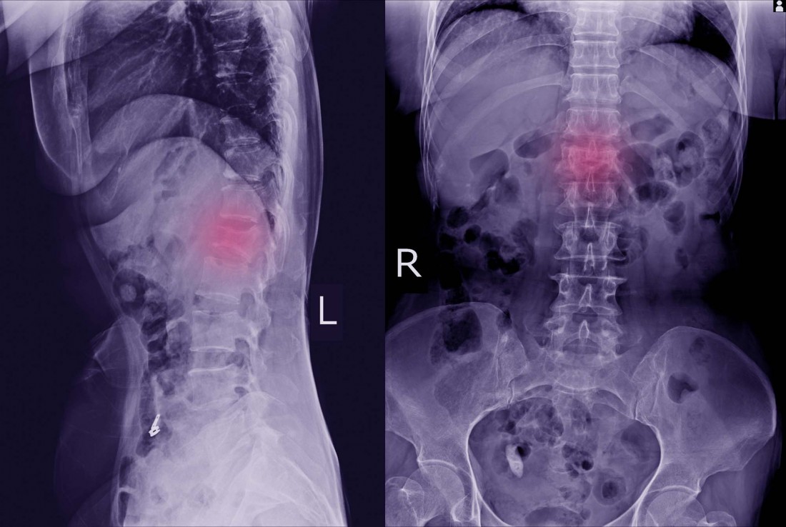 Radiculopathy Specialist Michigan | Dr. Todd Francis, M.D - compression-fracture