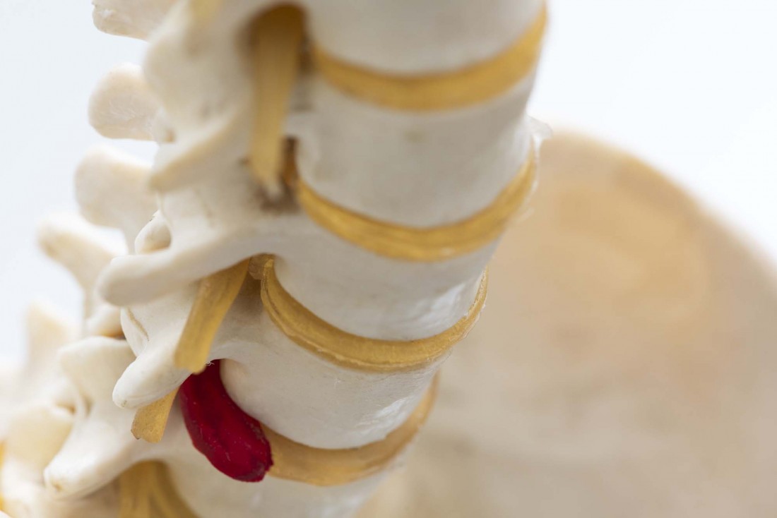 Radiculopathy Specialist Michigan | Dr. Todd Francis, M.D - herniated-disc