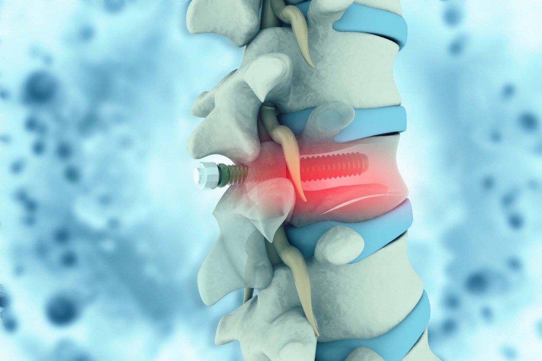 Top Spine Surgeons in Michigan | Dr. Todd Francis - spine-bolt