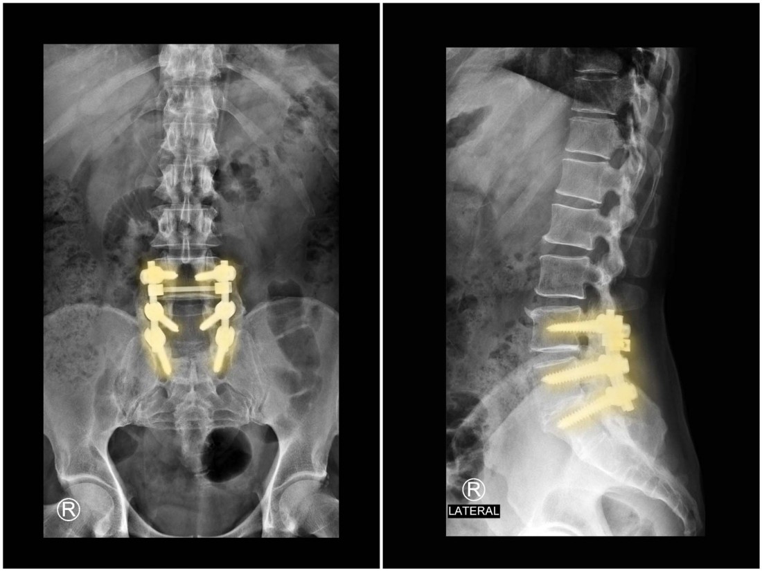 Adult Deformities Surgeon in Detroit, MI | Dr. Todd Francis - spine-fusion